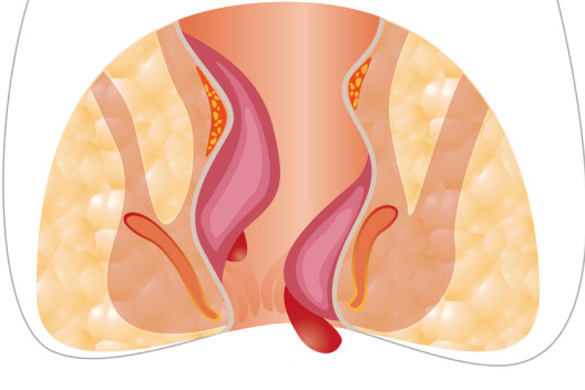 Fistula